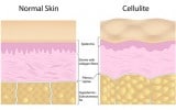 5 Myths About Cellulite You Shouldn't Believe