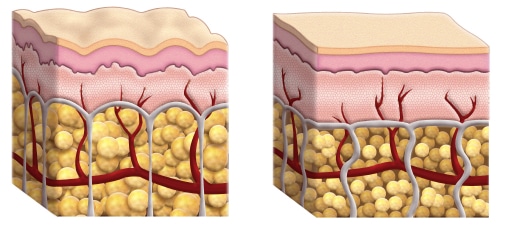 Is Exercise a Good Treatment for Cellulite?