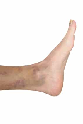 The Cause and Treatment of Bruises