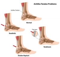 Is It Okay to Exercise With Tendonitis?
