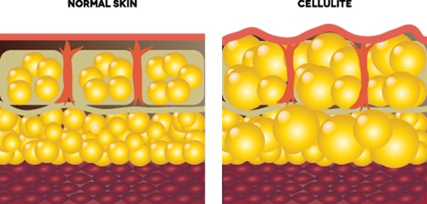 Since cellulite is essentially caused by fat, a natural correlation exists between the two. 