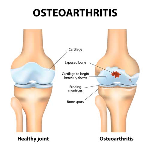 4 Powerful Ways to Protect Your Joints