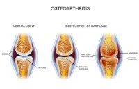 Can Diet & Nutrition Prevent or Slow the Development of Osteoarthritis?