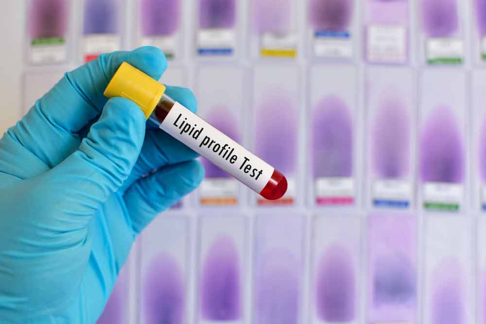 image of medical technician holding a blood lipid test sample