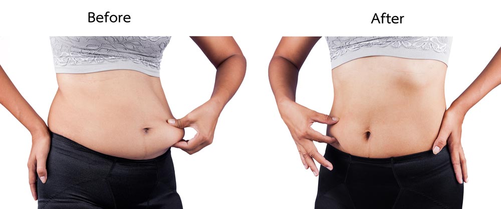 image of women body fat belly between before and after weight loss