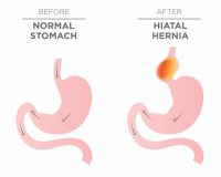 Hiatal Hernia Stomach Image