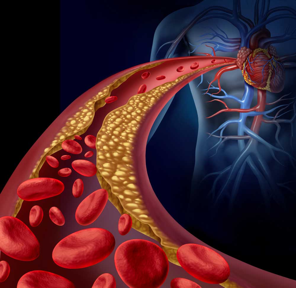 An ischemic stroke happens when a blood vessel carrying blood and oxygen to the brain forms a clot increasing the risk of stroke. 