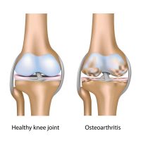 The length of your legs might cause you to have knee arthritis