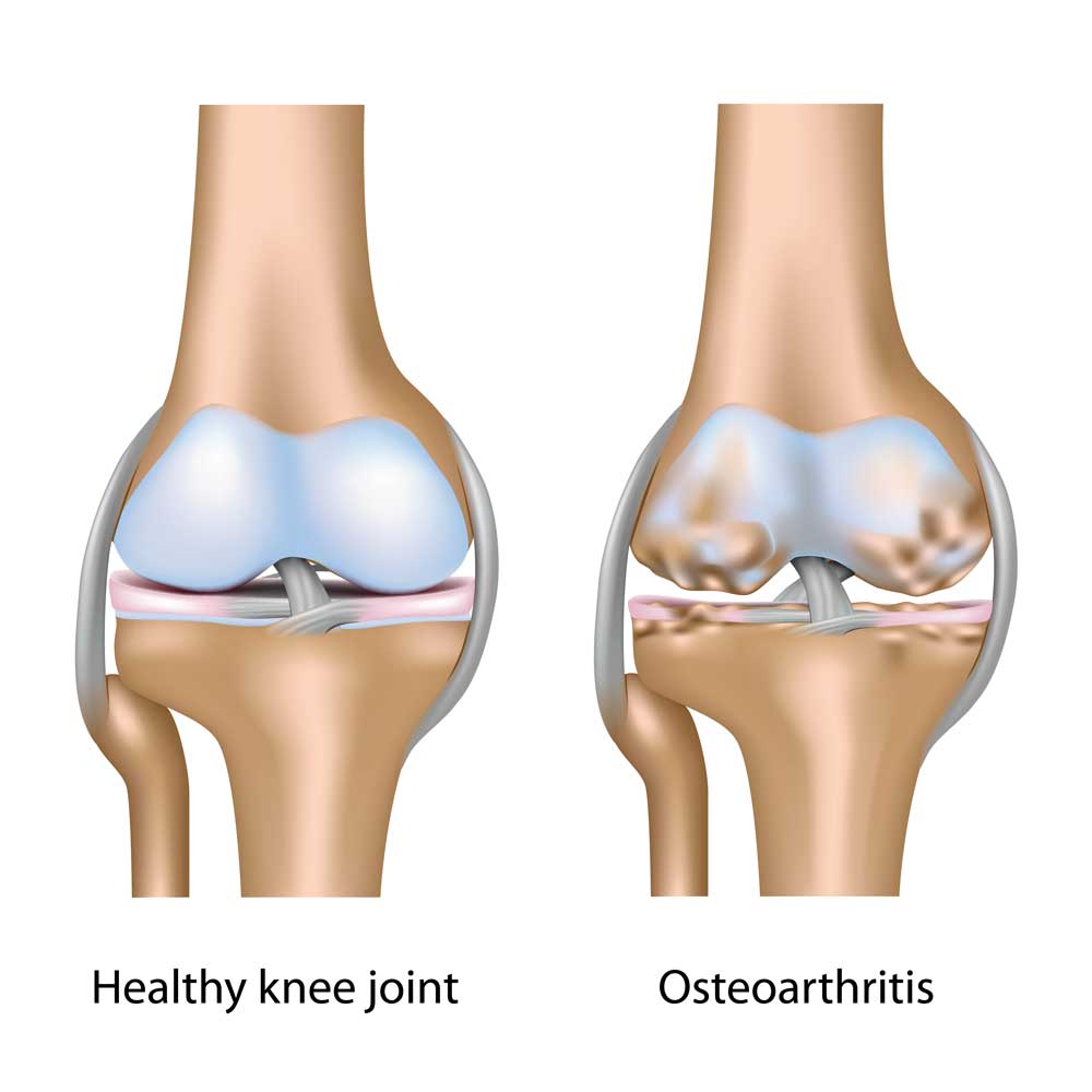 The length of your legs might cause you to have knee arthritis