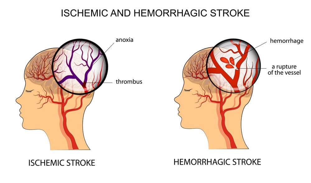 risk of stroke