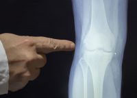 arthritis and joint health