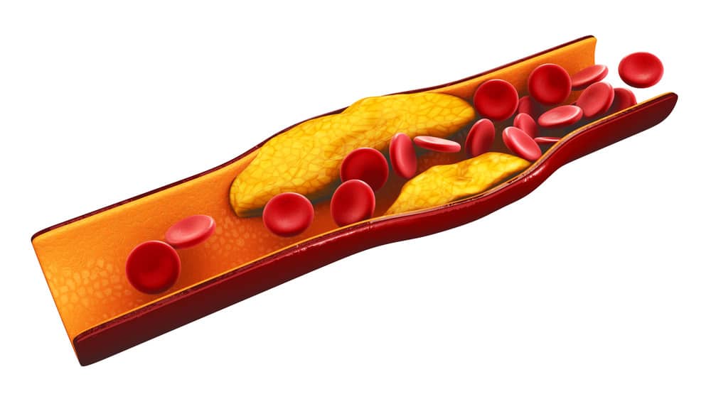 Coronary Calcium Scan to Determine Your Risk of Heart Disease