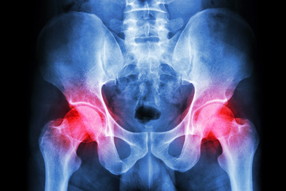 Hip Arthritis