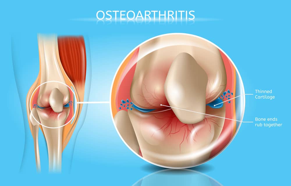 Knee Osteoarthritis