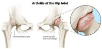 Hip arthritis