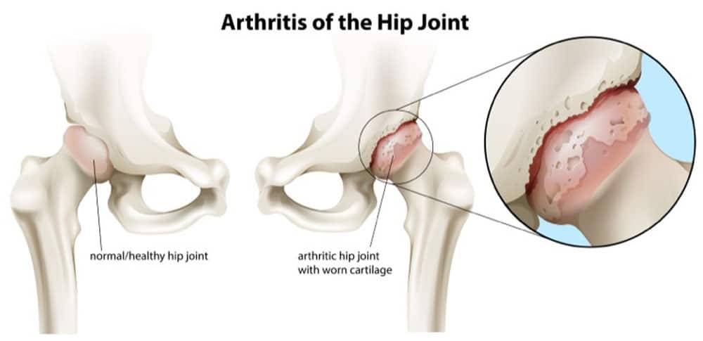 Hip arthritis