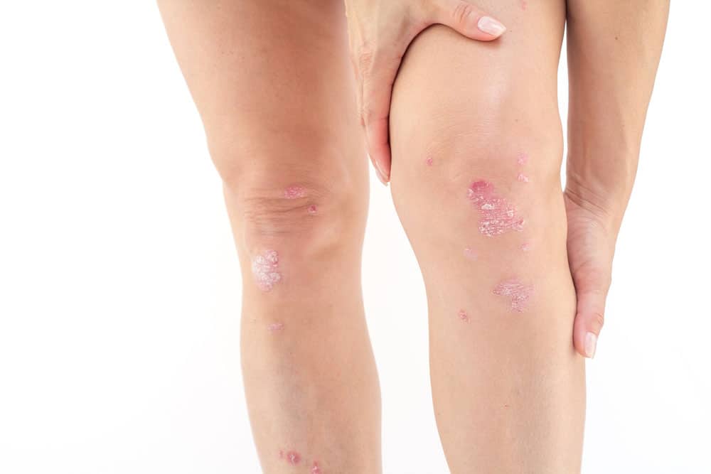 What Causes Water On The Knee Or Knee Effusion 